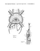 Methods for Anchoring Suture and Approximating Tissue diagram and image