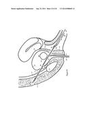 Methods for Anchoring Suture and Approximating Tissue diagram and image