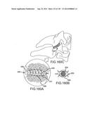 VERTEBRAL JOINT IMPLANTS AND DELIVERY TOOLS diagram and image