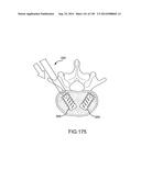 VERTEBRAL JOINT IMPLANTS AND DELIVERY TOOLS diagram and image