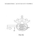 VERTEBRAL JOINT IMPLANTS AND DELIVERY TOOLS diagram and image