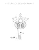 VERTEBRAL JOINT IMPLANTS AND DELIVERY TOOLS diagram and image