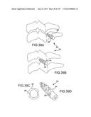 VERTEBRAL JOINT IMPLANTS AND DELIVERY TOOLS diagram and image