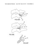 VERTEBRAL JOINT IMPLANTS AND DELIVERY TOOLS diagram and image