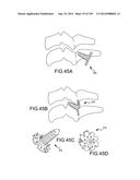 VERTEBRAL JOINT IMPLANTS AND DELIVERY TOOLS diagram and image