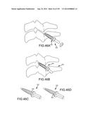 VERTEBRAL JOINT IMPLANTS AND DELIVERY TOOLS diagram and image