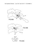 VERTEBRAL JOINT IMPLANTS AND DELIVERY TOOLS diagram and image