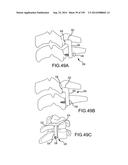 VERTEBRAL JOINT IMPLANTS AND DELIVERY TOOLS diagram and image