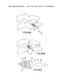 VERTEBRAL JOINT IMPLANTS AND DELIVERY TOOLS diagram and image