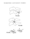 VERTEBRAL JOINT IMPLANTS AND DELIVERY TOOLS diagram and image