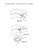 VERTEBRAL JOINT IMPLANTS AND DELIVERY TOOLS diagram and image