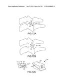 VERTEBRAL JOINT IMPLANTS AND DELIVERY TOOLS diagram and image