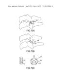 VERTEBRAL JOINT IMPLANTS AND DELIVERY TOOLS diagram and image