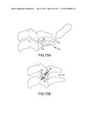 VERTEBRAL JOINT IMPLANTS AND DELIVERY TOOLS diagram and image