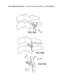 VERTEBRAL JOINT IMPLANTS AND DELIVERY TOOLS diagram and image