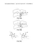 VERTEBRAL JOINT IMPLANTS AND DELIVERY TOOLS diagram and image