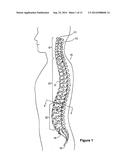 ODONTOID FRACTURE DYNAMIC COMPRESSION APPARATUS AND METHOD diagram and image