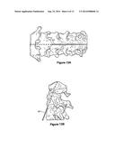 ODONTOID FRACTURE DYNAMIC COMPRESSION APPARATUS AND METHOD diagram and image