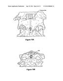 ODONTOID FRACTURE DYNAMIC COMPRESSION APPARATUS AND METHOD diagram and image