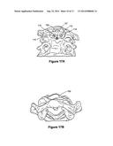 ODONTOID FRACTURE DYNAMIC COMPRESSION APPARATUS AND METHOD diagram and image