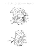 ODONTOID FRACTURE DYNAMIC COMPRESSION APPARATUS AND METHOD diagram and image