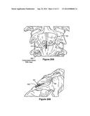 ODONTOID FRACTURE DYNAMIC COMPRESSION APPARATUS AND METHOD diagram and image