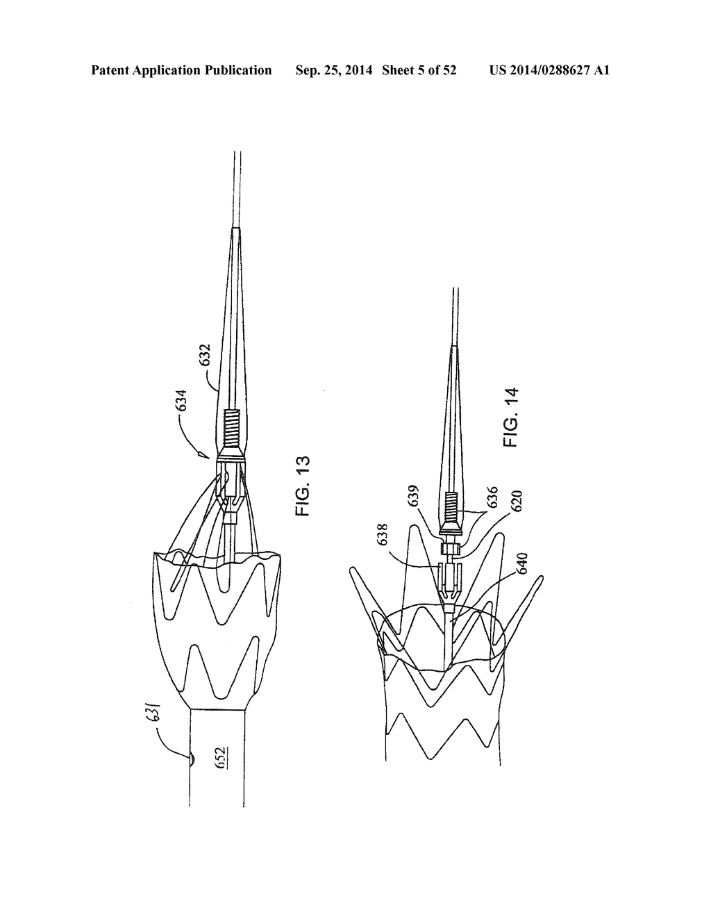 SYSTEM FOR IMPLANTING A PROSTHESIS - diagram, schematic, and image 06