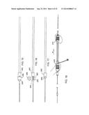 SYSTEM FOR IMPLANTING A PROSTHESIS diagram and image