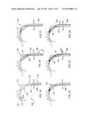 SYSTEM FOR IMPLANTING A PROSTHESIS diagram and image