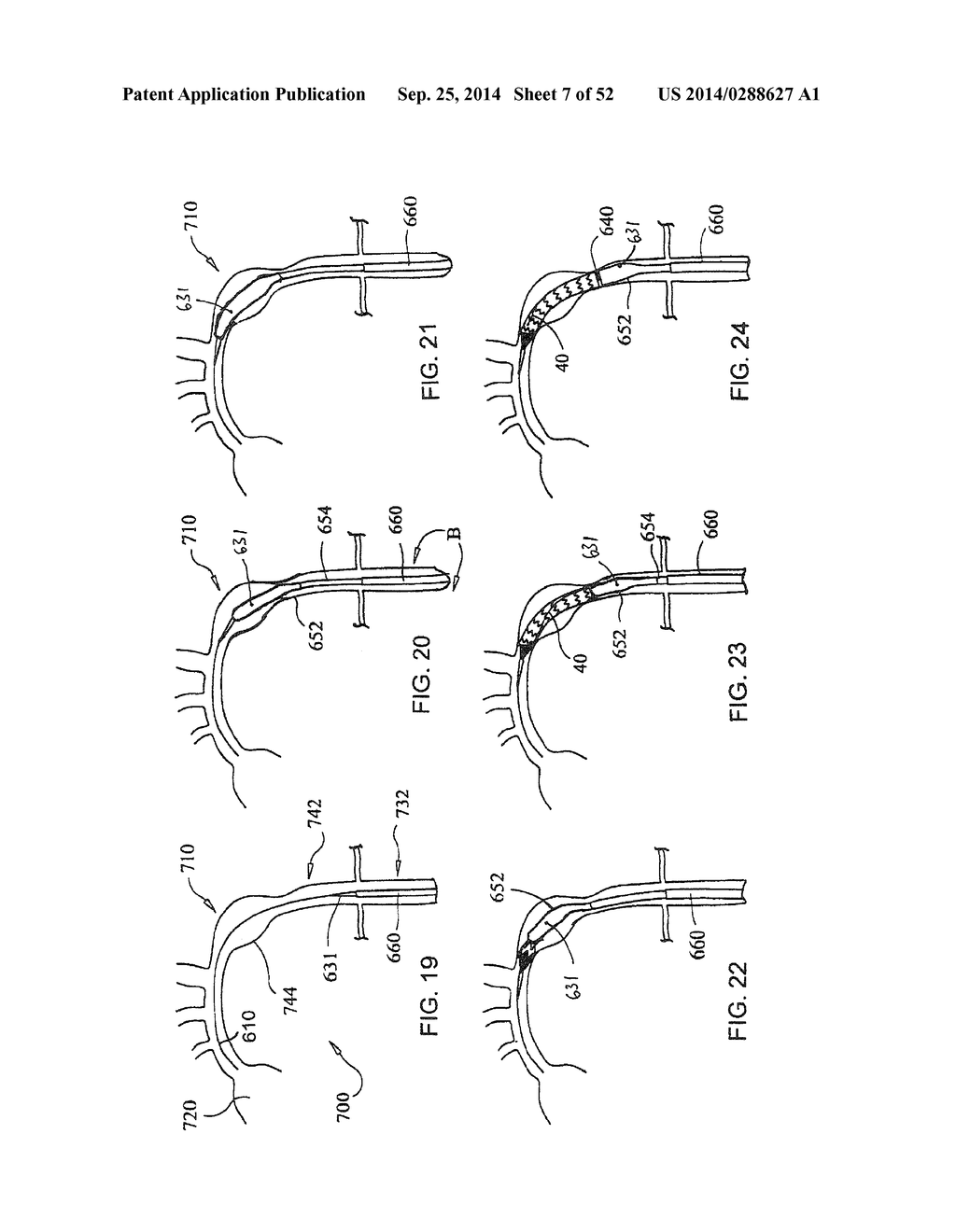 SYSTEM FOR IMPLANTING A PROSTHESIS - diagram, schematic, and image 08