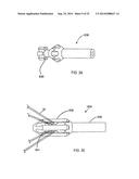 SYSTEM FOR IMPLANTING A PROSTHESIS diagram and image