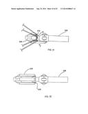 SYSTEM FOR IMPLANTING A PROSTHESIS diagram and image