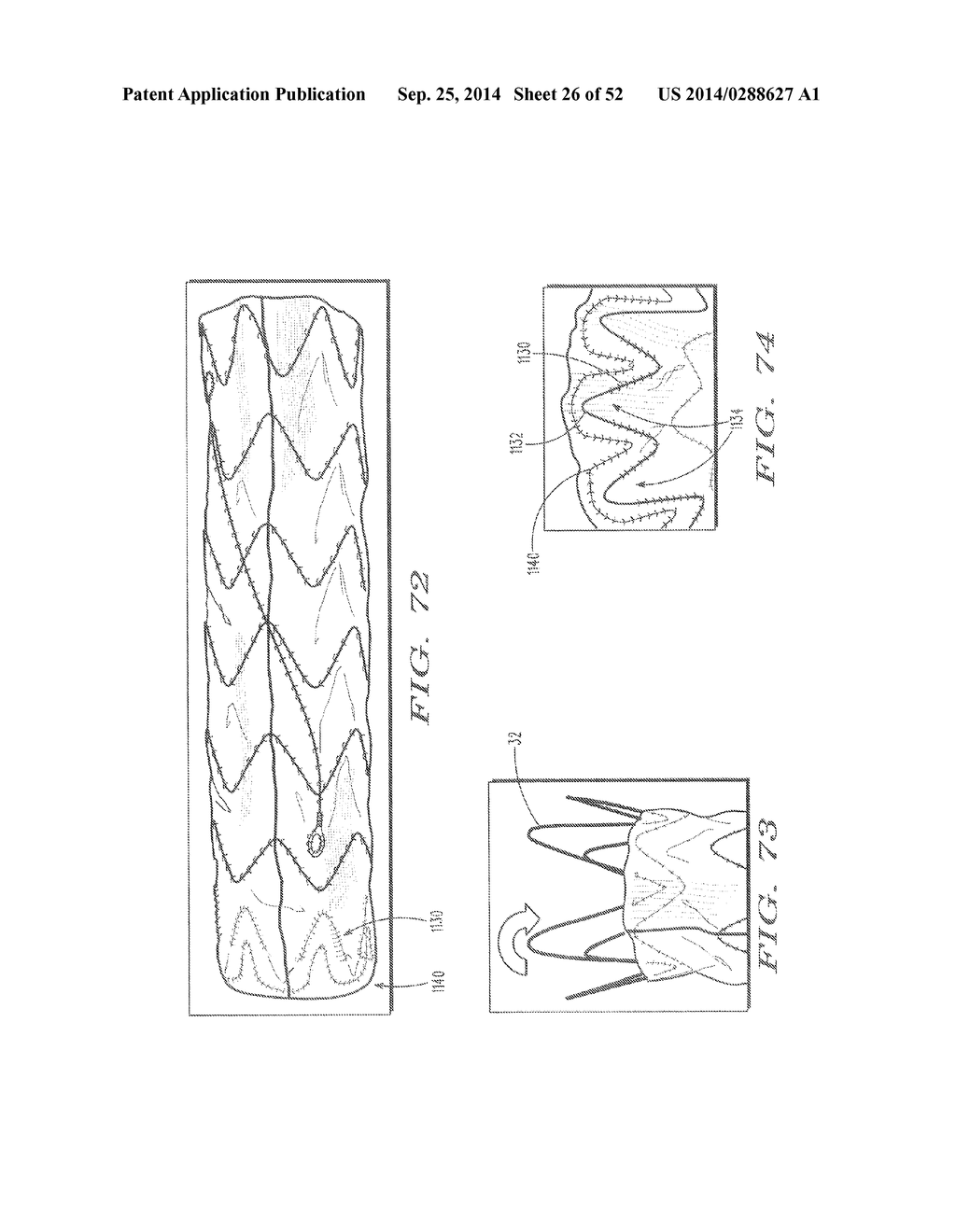 SYSTEM FOR IMPLANTING A PROSTHESIS - diagram, schematic, and image 27