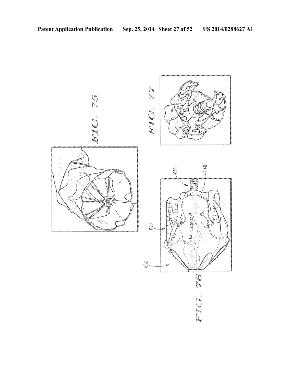 SYSTEM FOR IMPLANTING A PROSTHESIS - diagram, schematic, and image 28