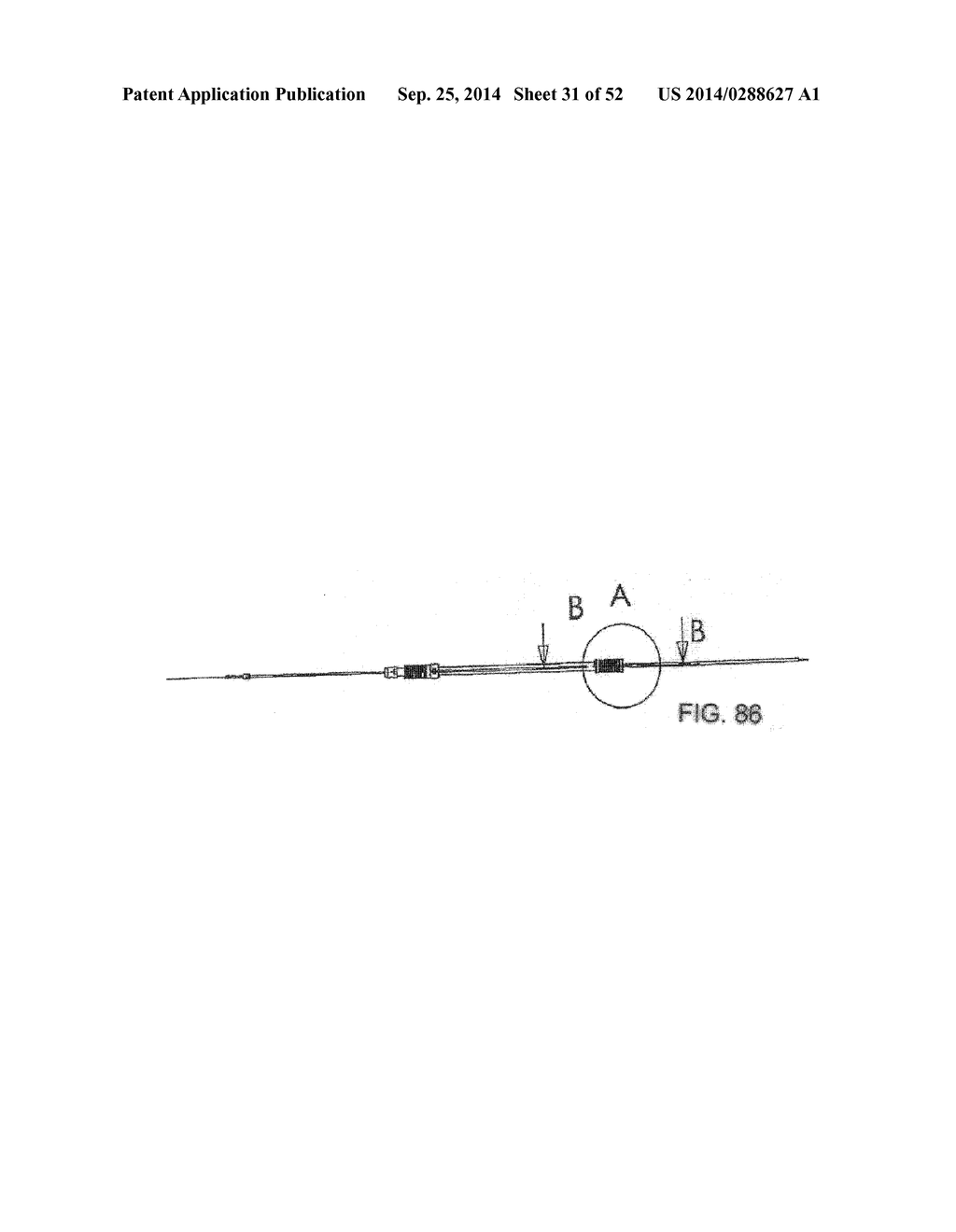 SYSTEM FOR IMPLANTING A PROSTHESIS - diagram, schematic, and image 32