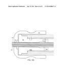 SYSTEM FOR IMPLANTING A PROSTHESIS diagram and image