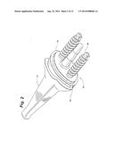 Prosthetic Wrist Implant diagram and image