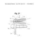 Prosthetic Wrist Implant diagram and image