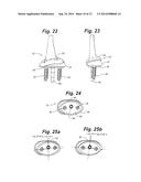 Prosthetic Wrist Implant diagram and image