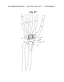 Prosthetic Wrist Implant diagram and image