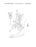 TREATMENT OF CARPAL TUNNEL SYNDROME BY INJECTION OF THE FLEXOR RETINACULUM diagram and image