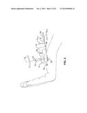 TREATMENT OF CARPAL TUNNEL SYNDROME BY INJECTION OF THE FLEXOR RETINACULUM diagram and image