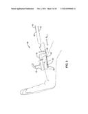 TREATMENT OF CARPAL TUNNEL SYNDROME BY INJECTION OF THE FLEXOR RETINACULUM diagram and image