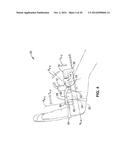 TREATMENT OF CARPAL TUNNEL SYNDROME BY INJECTION OF THE FLEXOR RETINACULUM diagram and image