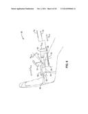 TREATMENT OF CARPAL TUNNEL SYNDROME BY INJECTION OF THE FLEXOR RETINACULUM diagram and image