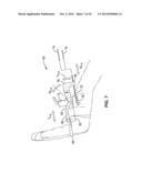 TREATMENT OF CARPAL TUNNEL SYNDROME BY INJECTION OF THE FLEXOR RETINACULUM diagram and image