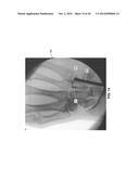 TREATMENT OF CARPAL TUNNEL SYNDROME BY INJECTION OF THE FLEXOR RETINACULUM diagram and image