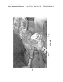 TREATMENT OF CARPAL TUNNEL SYNDROME BY INJECTION OF THE FLEXOR RETINACULUM diagram and image