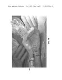TREATMENT OF CARPAL TUNNEL SYNDROME BY INJECTION OF THE FLEXOR RETINACULUM diagram and image