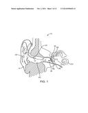 Optical Electro-Mechanical Hearing Devices with Separate Power and Signal     Components diagram and image